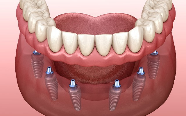 A diagram of a lower implant denture