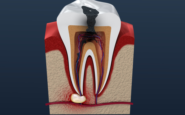 Highlighted x ray of a toothache in Fort Worth